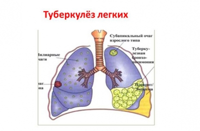 Лечение туберкулёза — Википедия